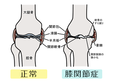 正常な膝と膝関節症の膝